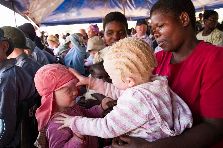 Albinism Albino_afp