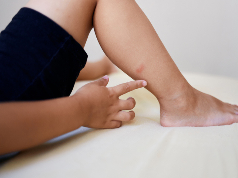 A childs hand scratches a mosquito bite on their leg