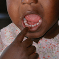 A little girl points to her tooth