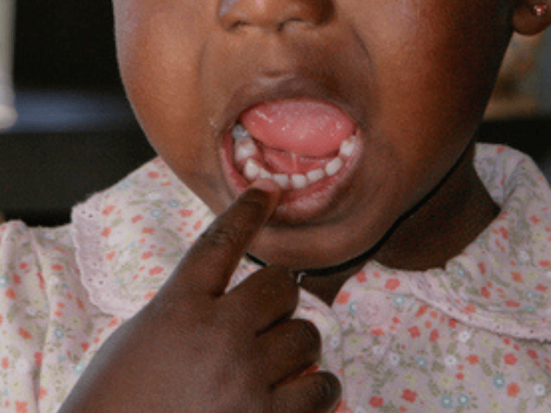 A little girl points to her tooth