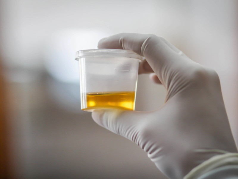 Urine sample