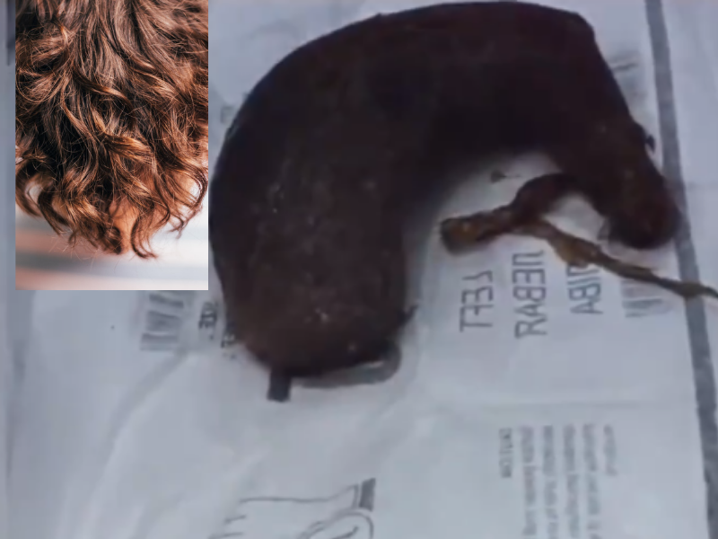 WATCH: Doctors remove 2.7kg of hair from an 11-year-old's stomach