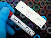 Blood sample of patient positive tested for tuberculosis by rapid diagnostic test
