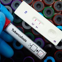 Blood sample of patient positive tested for tuberculosis by rapid diagnostic test