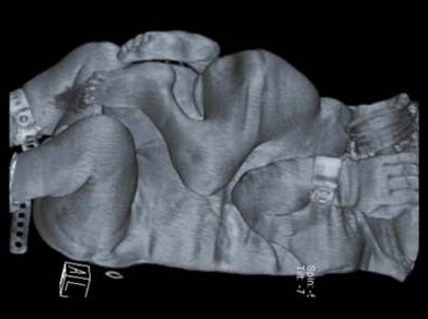 Conjoined-Twins.jpg