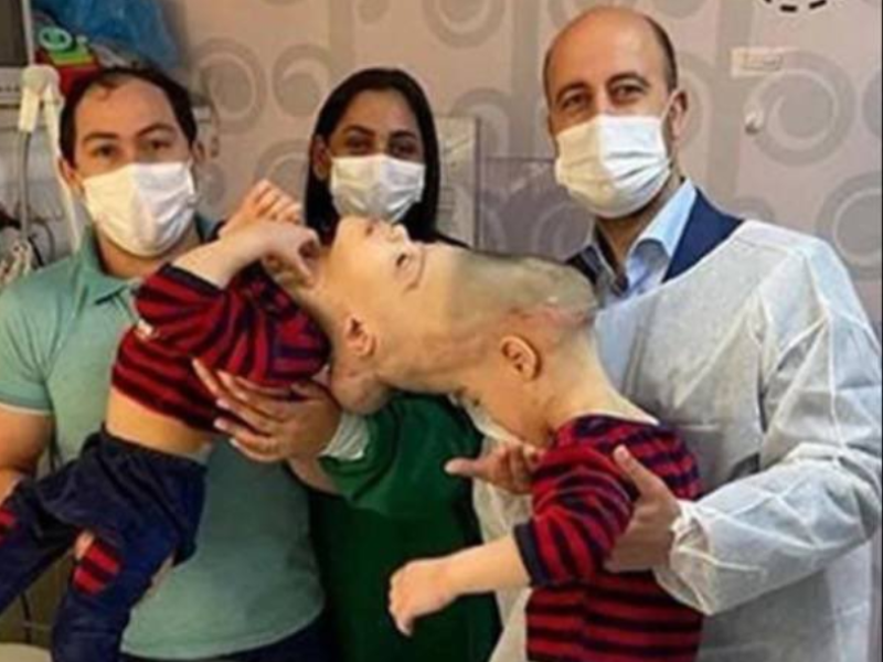 Conjoined twins from Brazil undergo surgery
