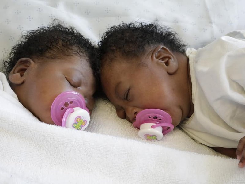 HAPPY NEWS: Conjoined twins are successfully separated