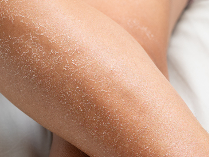 Dry skin on a womans legs due to dehydration