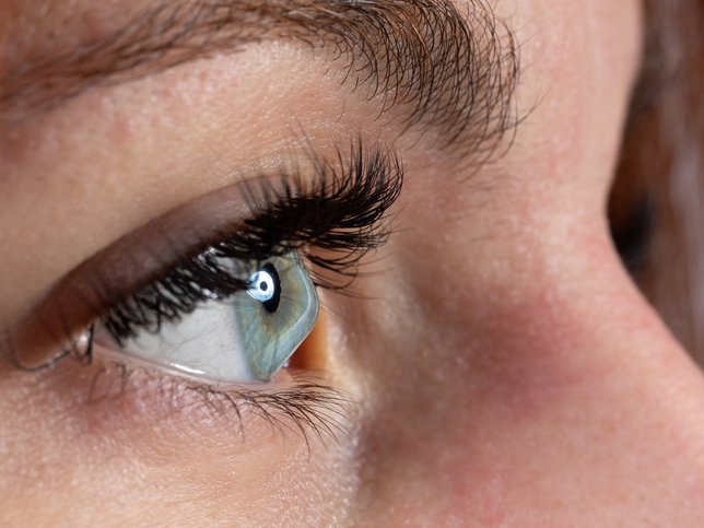Female eye affected by keratoconus