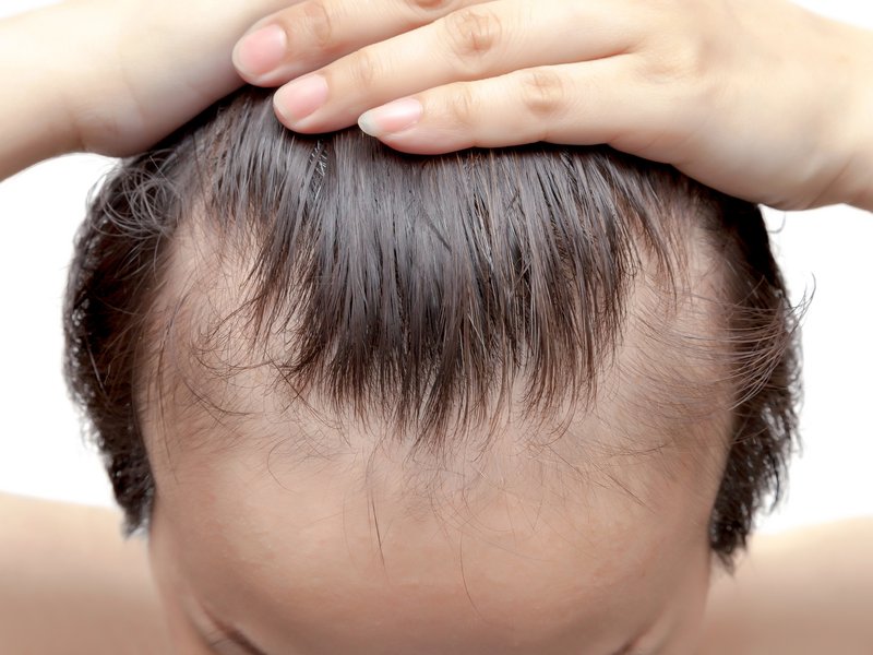 Hairline loss
