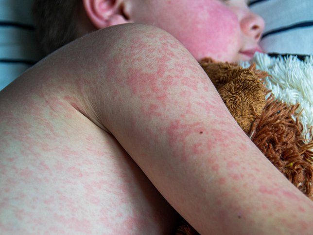 Measles