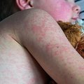 MEasles_iStock.max-800x600