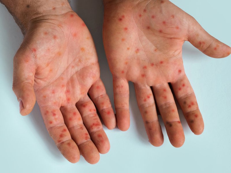 Male patient's hands with monkey pox