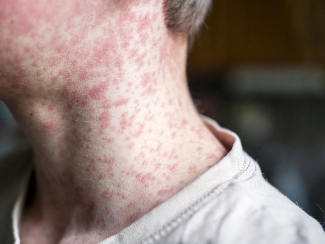 Measles viral disease