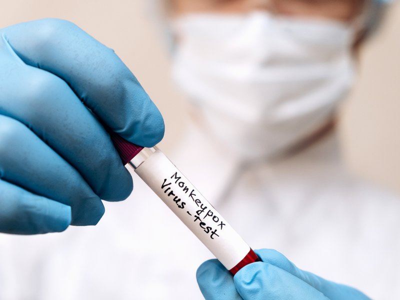 Monkeypox test iStock