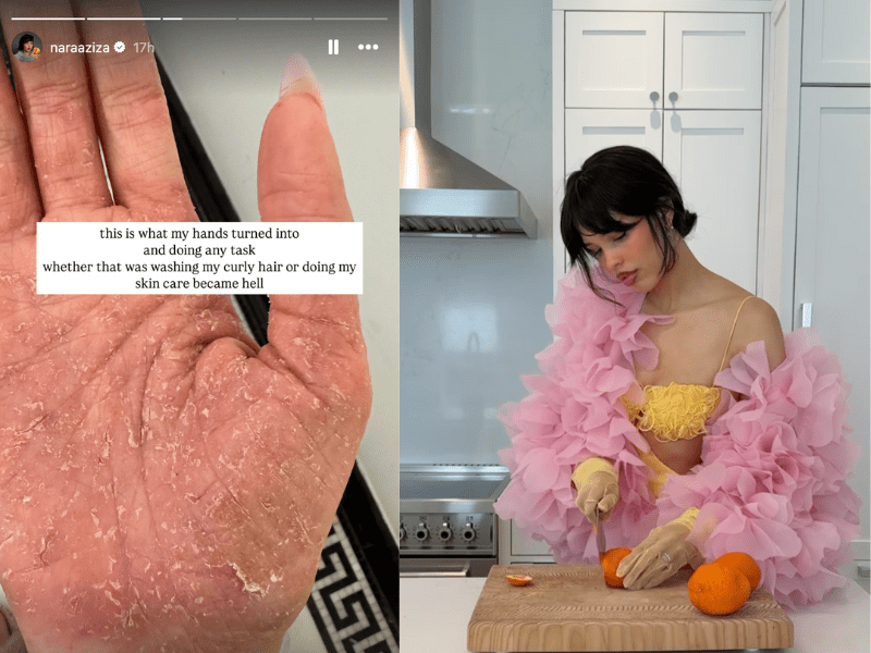 Nara Smith Eczema