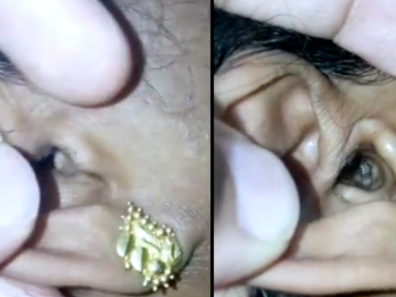 Spinder In Ear Doctors horrified after discovering spider hiding in woman's ear