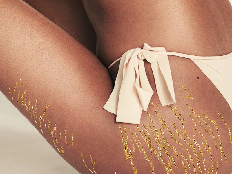 Stretch marks