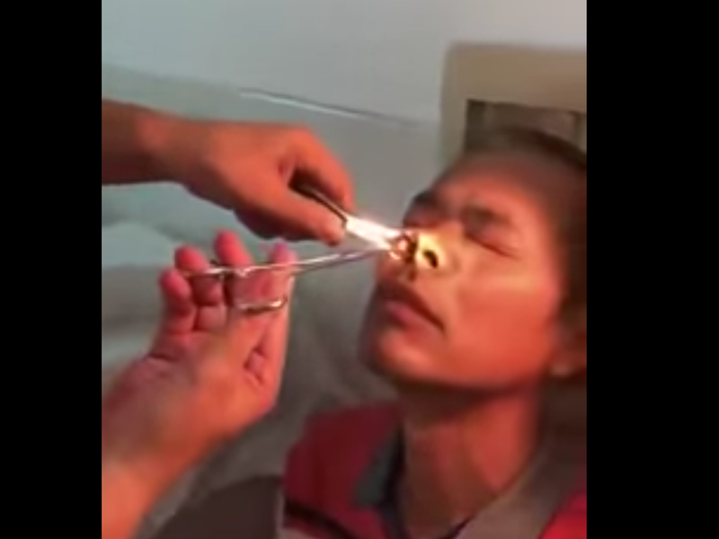 leech nose man youtube