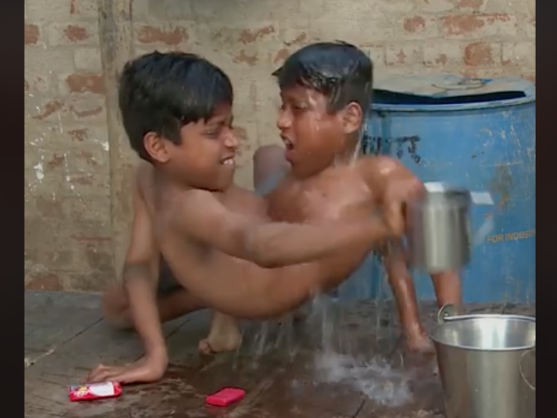 conjoined twins indian