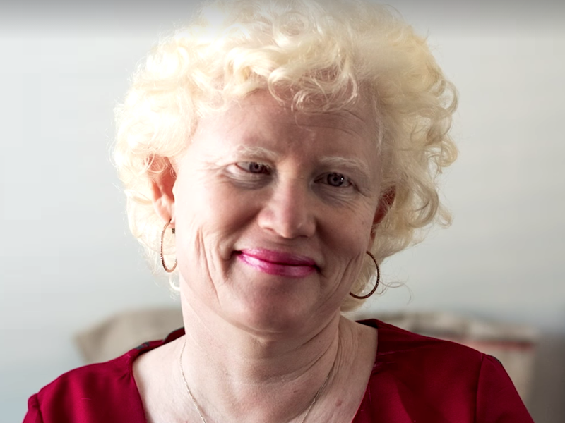 Albinism beautiful news
