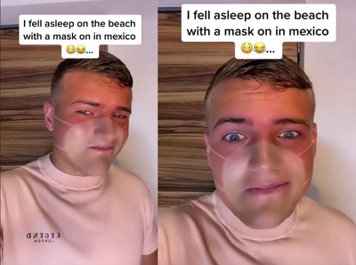 Man Left With Embarrassing Sunburn After Claiming To Fall Asleep On The Beach