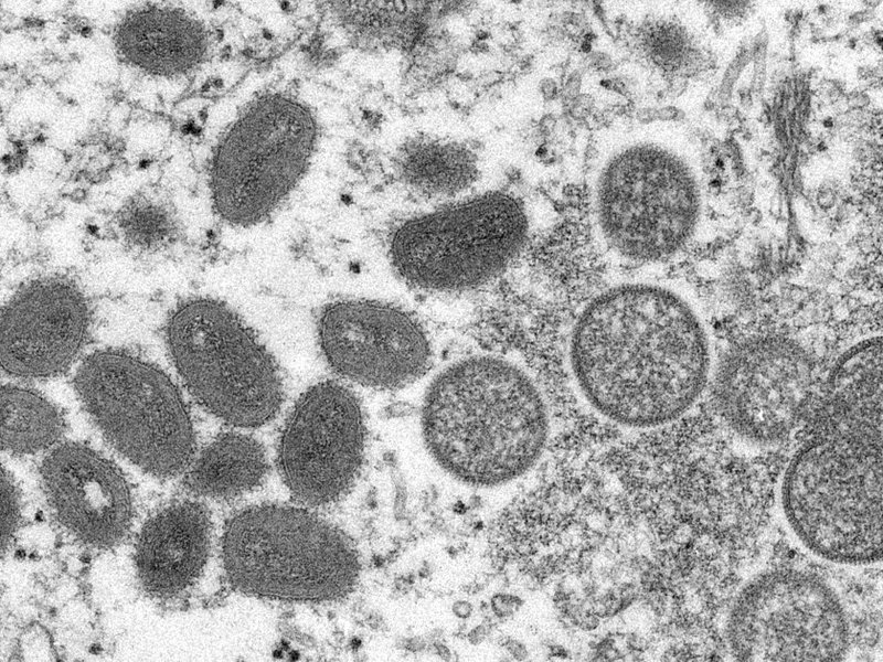 Monkeypox arrives in SA: What you need to know