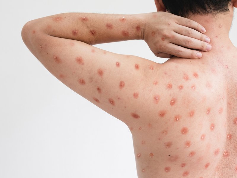 Boy infected with the monkeypox virus iStock