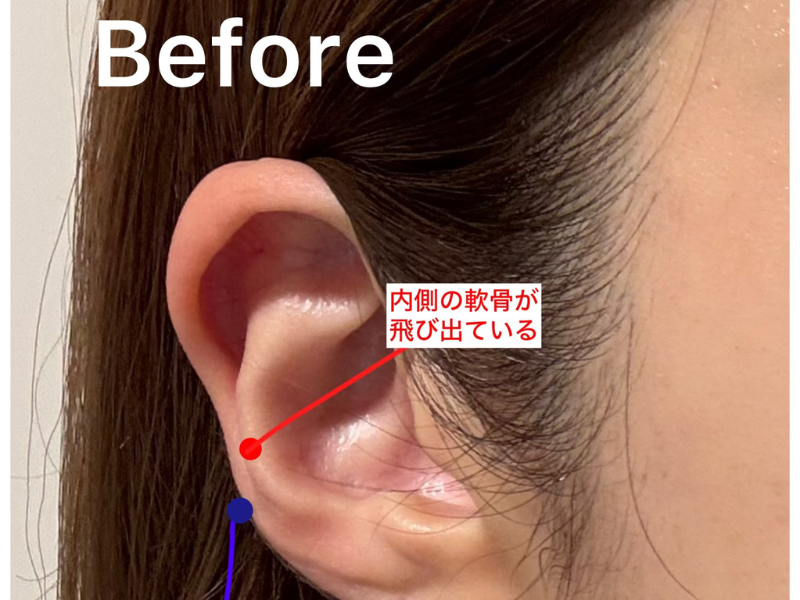WATCH: Ear fillers are the latest must-have beauty trend