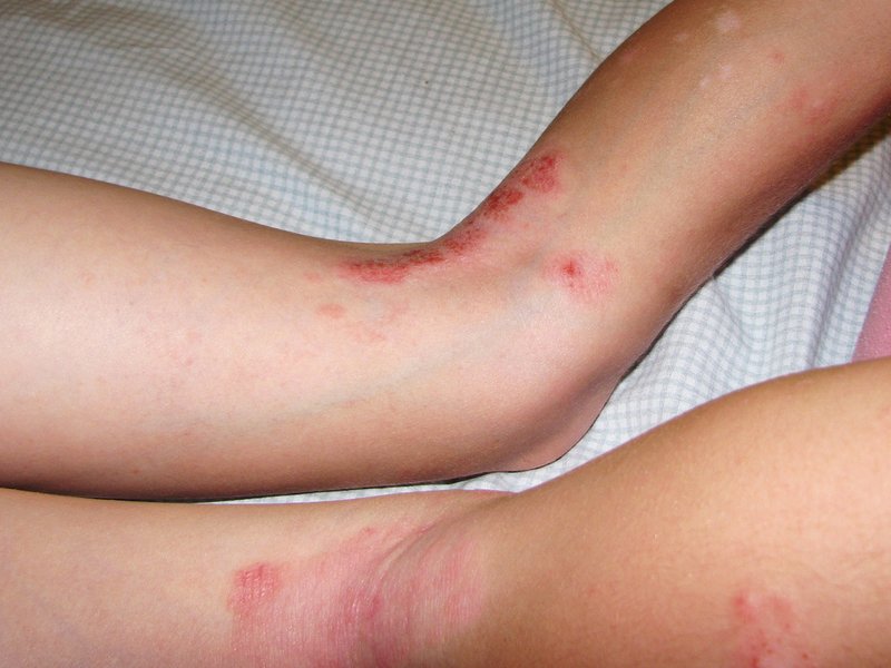 Eczema