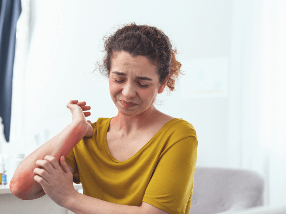 Eczema sufferer
