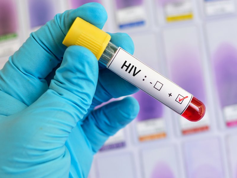 Blood sample positive with HIV test