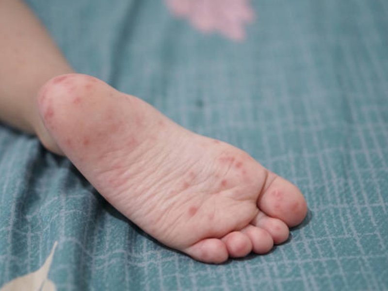 Call for calm after eThekwini hand foot, mouth outbreak