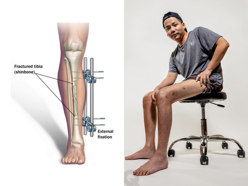 Leg-lengthening surgery sweeps the world off their feet!