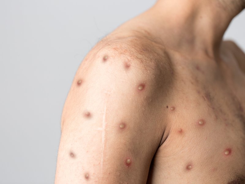 Monkeypox