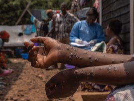 mpox Africa generic image