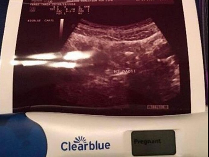 Pregnancy surprise news