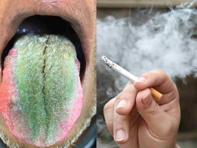 SEE: Man's tongue turns into the Grinch after smoking these cigarettes