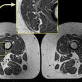abundant fatty streaks in thigh muscles