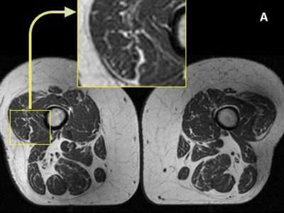 Study: Could ultraprocessed food be turning your muscles to fat?