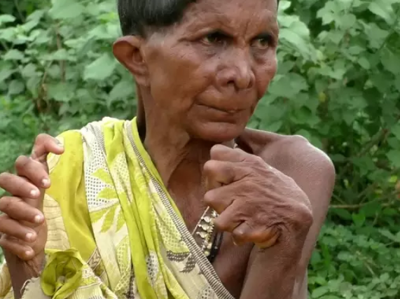 woman with multiple fingers and toes